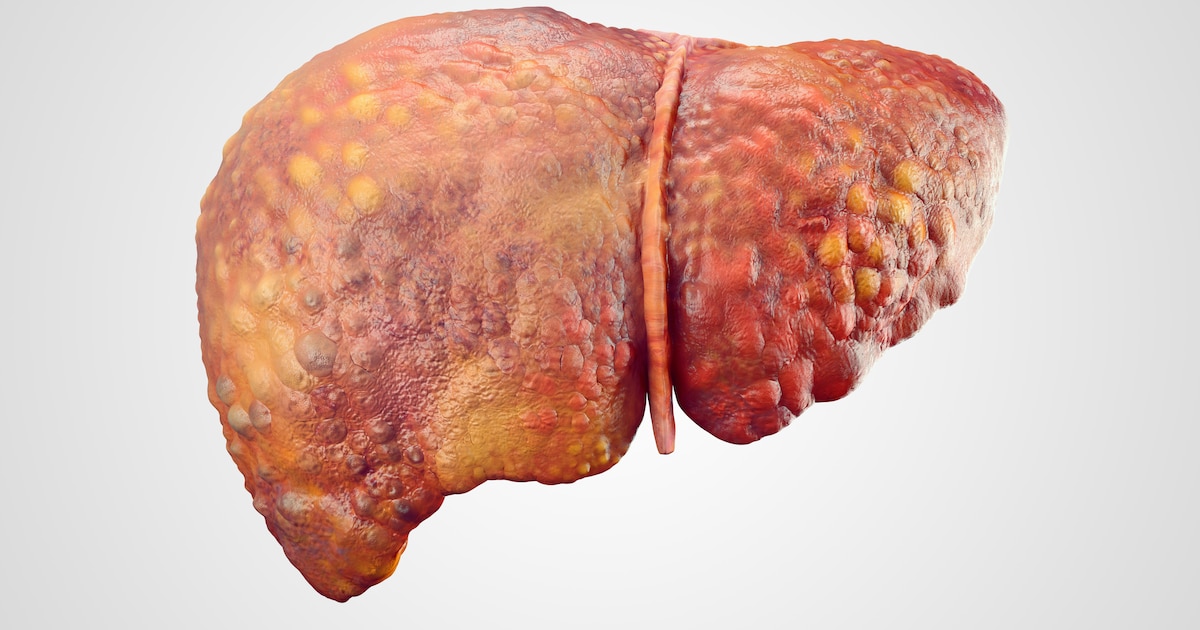 ¿Cuántos huevos puedo comer a la semana con hígado graso?